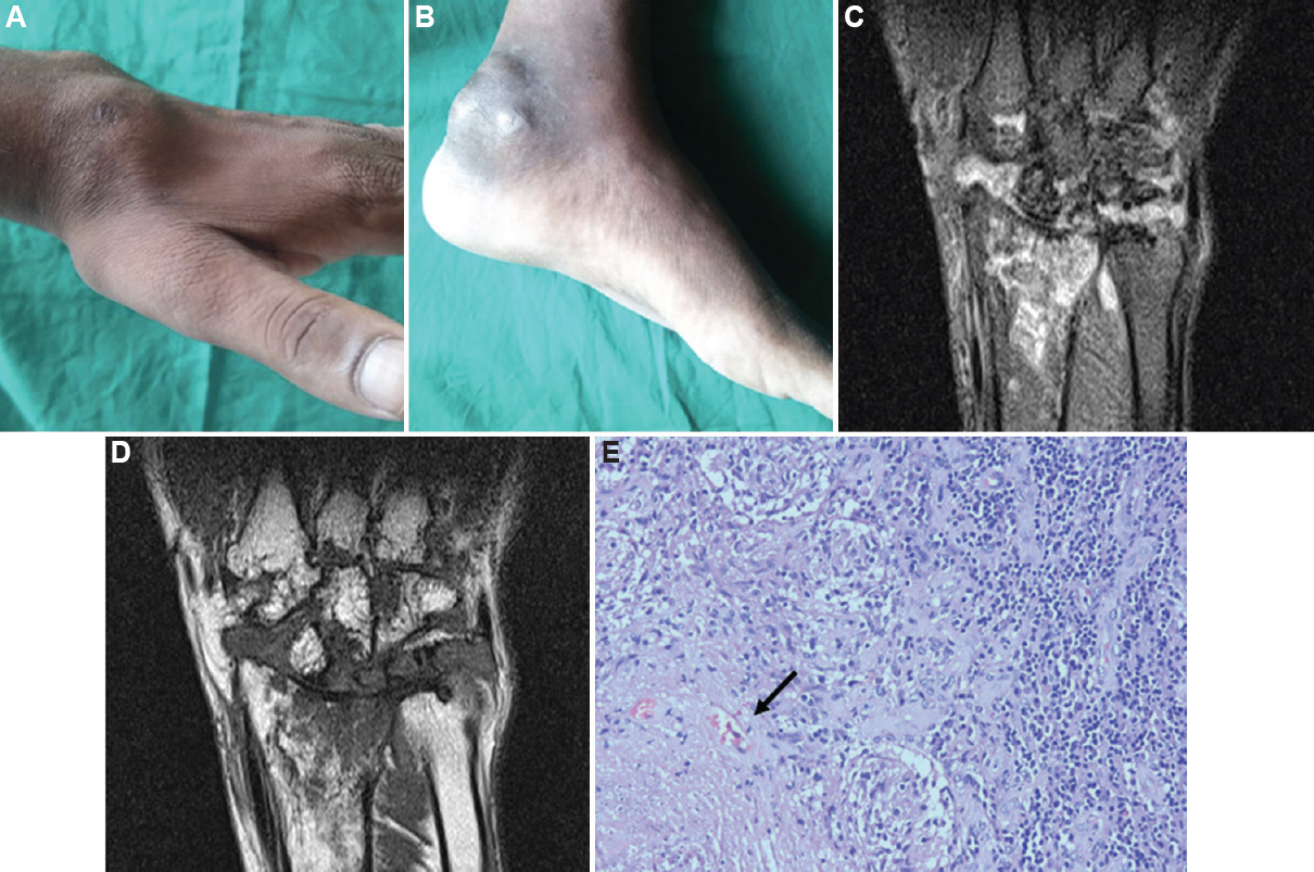 (A and B). Soft-tissue swelling at wrist joint and ankle joint, respectively. (C) Magnetic resonance imaging proton density image of right wrist shows bone marrow oedema and periarticular soft-tissue involvement. (D) Magnetic resonance imaging wrist T1-weighted image shows erosions at distal ulna, radius and carpal bones. (E) Biopsy of the synovium (HPE staining, ×400) showing granuloma with caseous necrosis (black arrow).